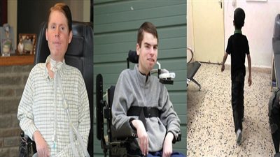 900 ألف مريض بضمور العضلات في مصر.. حالات الوفاة تتزايد.. الحكومة 