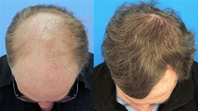 تعرف على الآثار الجانبية لعمليات زراعة الشعر