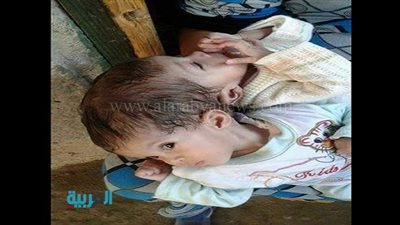 والد توأم ملتصق بالبحيرة يناشد وزير الصحة لإنقاذهما