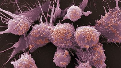 باحثون يقطعون خطوط الإمداد الغذائي للخلايا السرطانية لمنعها من النمو