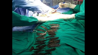 هندي يبتلع 40 سكينًا.. ماذا شاهد الأطباء في جسده؟