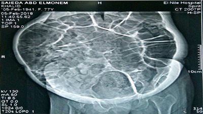 إستئصال ورم بالقولون من مسنة بمستشفي التامين الصحي ببنها