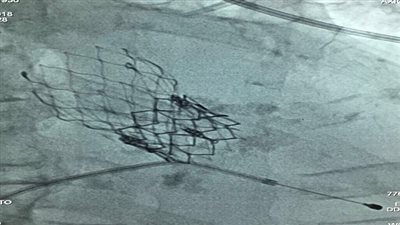 إنقاذ حياة سيدة ويجرى لها جراحة تركيب صمام أورطى