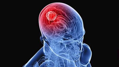 إستئصال ورم سرطانى يبلغ 40 كيلو من رحم سيدة بمركز أورام طنطا