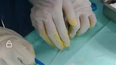 صحة الدقهلية.. توفير خدمة الغسيل الكلوي البروتوني للأطفال بمستشفى السنبلاوين العام