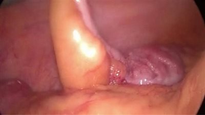 مستشفى السويس العام تعيد تشغيل جراحات المناظير