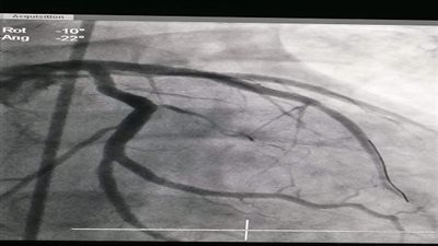 نجاح فريق طبي بإنقاذ حياة مريض مصاب بجلطة حديثة بالشريان التاجي بمستشفى المنصورة الدولي