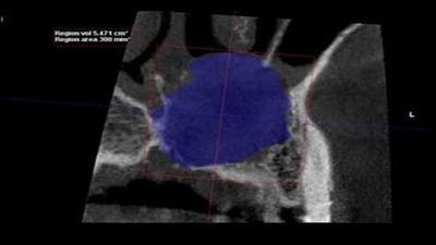 نجاح فريق طبي بإستئصال كيس بالفك العلوى لشاب بمستشفى ميت غمر دقهلية