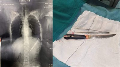 نجاح فريق طبي في انقاذ حياة مريض ابتلع سكين بمستشفى المنصورة الدولي