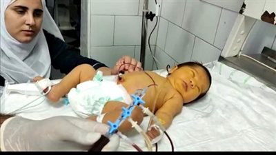 صحة الدقهلية.. تغيير دم كامل لطفل مبتسر  في الساعات الاولى من عمره بمستشفى شربين المركزي 