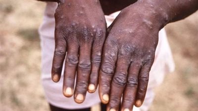 جُدري القرود.. بلجيكا تُعلن فرض الحجر الإلزامي لهذه الحالات!!