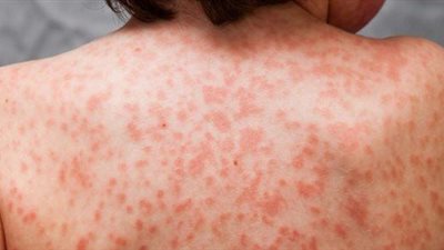 الصحة: مرض جدرى القرود لا ينتشر بسهولة