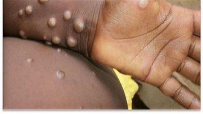 وزارة الصحة تصدر الدليل الإرشادى للتعامل مع جدرى القرود