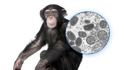 الصحة: لا يوجد علاج محدد لجدرى القرود حتى الآن 