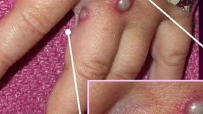 الصحة اللبنانية: تسجيل أول إصابة بجدرى القرود