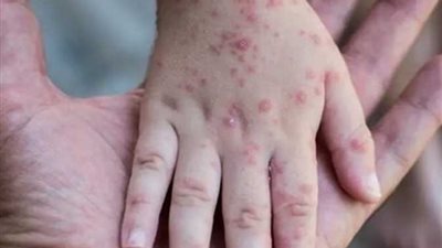 الصحة تكشف طرق انتشار جدرى القرود