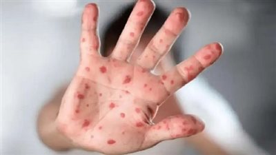 الصحة: احتمال انتشار جدرى القرود بالشرق الأوسط غير متوقع