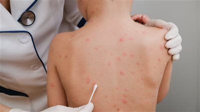 اكتشاف حالة مصابة بسلالة جديدة من جدري القرود في بريطانيا