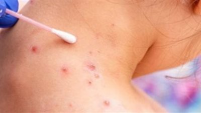 نيوزيلندا تسجل خامس حالة إصابة بجدري القردة