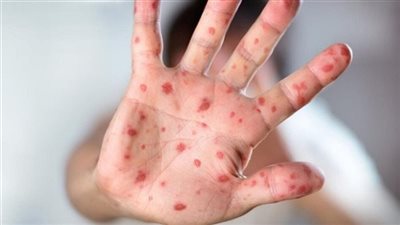 حالة جديدة للاصابة بجدري القرود في مصر.. اعرف التفاصيل