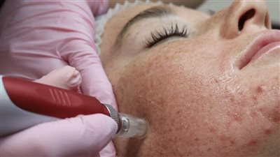 لكي سيدتي.. جلسات الديرمابين لتجديد خلايا البشرة 