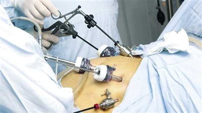 أدت لوفاة نجل جورج وسوف.. اعرف مخاطر جراحة تكميم المعدة