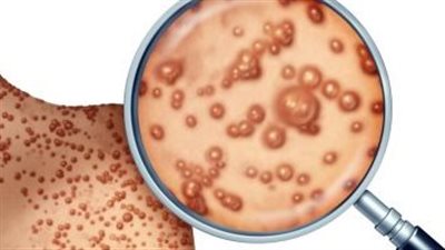 تسجيل 32 وفاة وأكثر من 30 ألف إصابة بجدري القردة بالولايات المتحدة