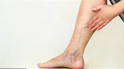 هيئة الدواء: السيدات أكثر عرضة للإصابة بدوالى الساقين.. بالأخص الحوامل