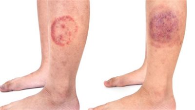 السبب إحدى أنواع الفطريات.. إحذر السعفة الجلدية