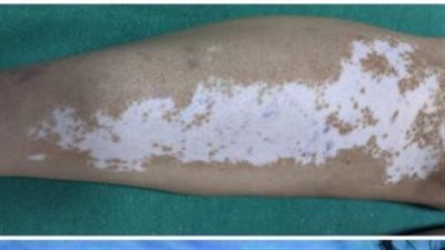 الصحة تكشف أسباب الإصابة بالبهاق وخبير يوضح طرق العلاج