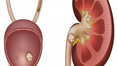 كيف تحمي نفسك من الحصوات الكلوية؟