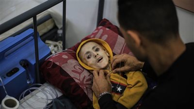 إتحول لهيكل عظمي.. صور صادمة لطفل 