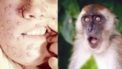 وزارة الصحة: لدينا استراتيجية واضحة للتعامل مع مرض جدرى القرود