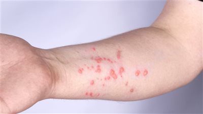 هل توجد أي حالات لجدري القرود داخل مصر