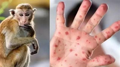 الجابون تعلن اكتشاف أول حالة إصابة بجدرى القردة