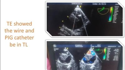 الرعاية الصحية تعلن نجاح تدخل جراحي مزدوج لأول مرة بإقليم جنوب الصعيد يجمع بين جراحة القلب المفتوح وتركيب دعامات مغطاة