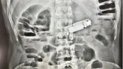 استخراج هاتف من معدة مريض بعملية طارئة في الغردقة