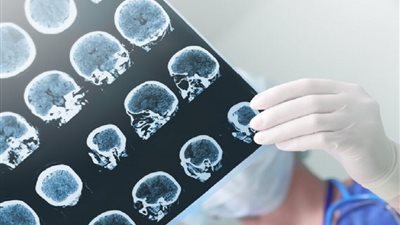 كيف تؤثر وجبة واحدة دسمة على دماغك؟