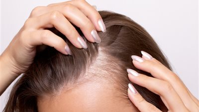 علاج فعّال لتساقط الشعر يحقق نتائج ملحوظة خلال شهرين فقط