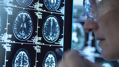 اكتشاف آلية ثورية لمكافحة ألزهايمر باستخدام مادة طبيعية في الجسم