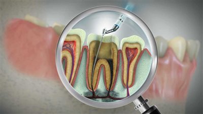 كيف يساهم علاج عصب الأسنان في صحة القلب؟