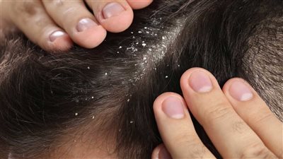 كيف يساعد الزنك في مكافحة قشرة الشعر؟