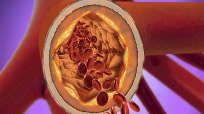 دواء جديد يخفض الكوليسترول الضار بنسبة قياسية