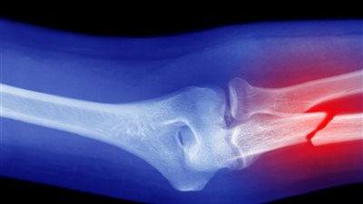 طريقة جديدة للكشف عن خطر الإصابة بهشاشة العظام