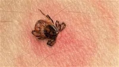لدغة القرادة    