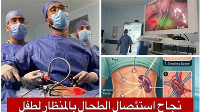 إنجاز طبي جديد بجامعة قناة السويس.. نجاح أول عملية استئصال كامل للطحال بالمنظار لطفل